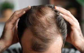 Alopecia: qué es, causas y tipos de alopecia
