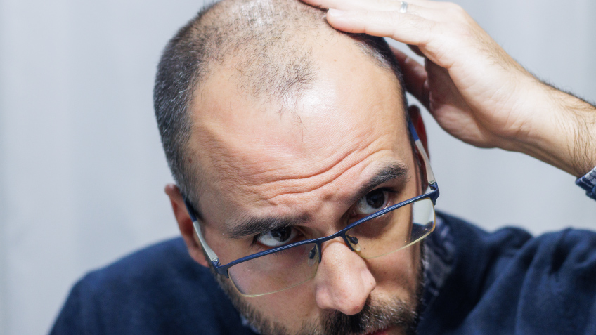 Precauciones del uso de finasteride y minoxidil