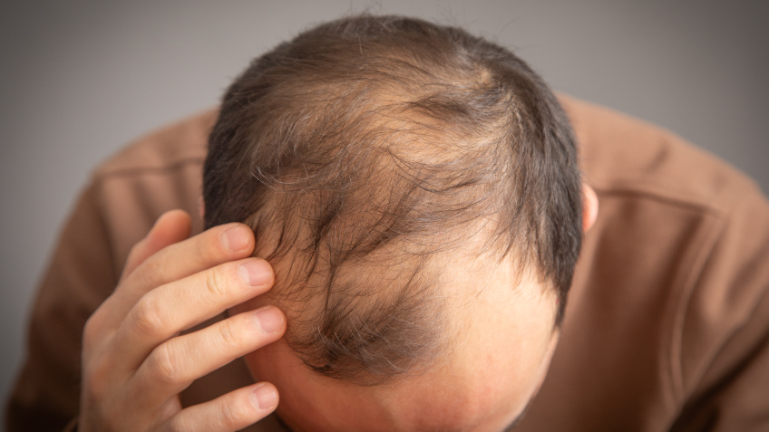 Precauciones del uso de finasteride y minoxidil