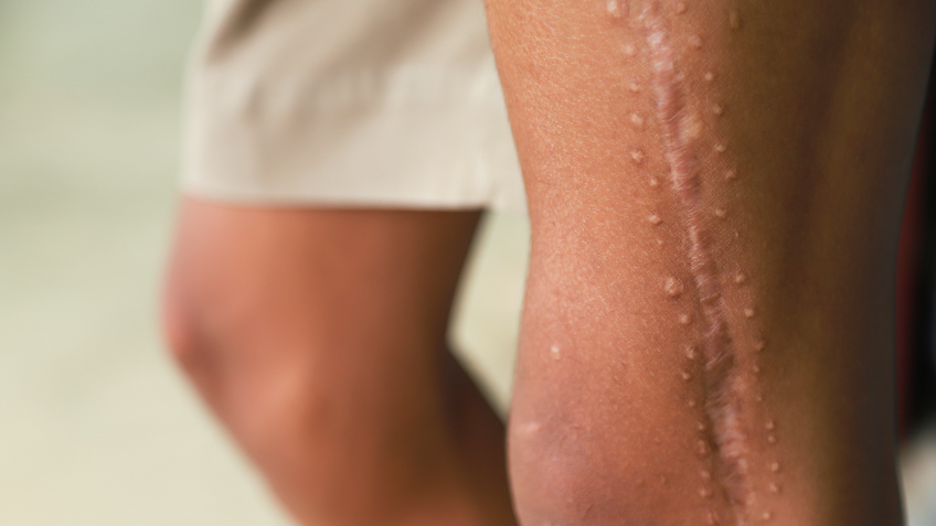 Qué es una cicatriz y cuáles son sus tipos