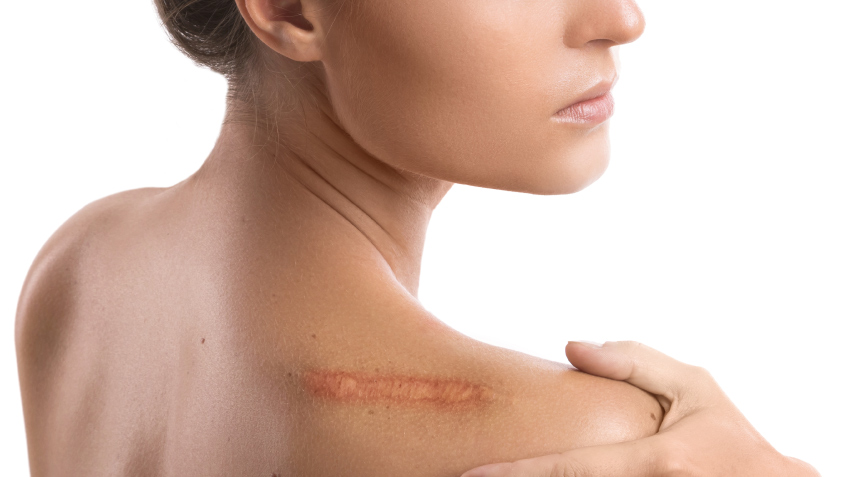 Qué es una cicatriz y cuáles son sus tipos