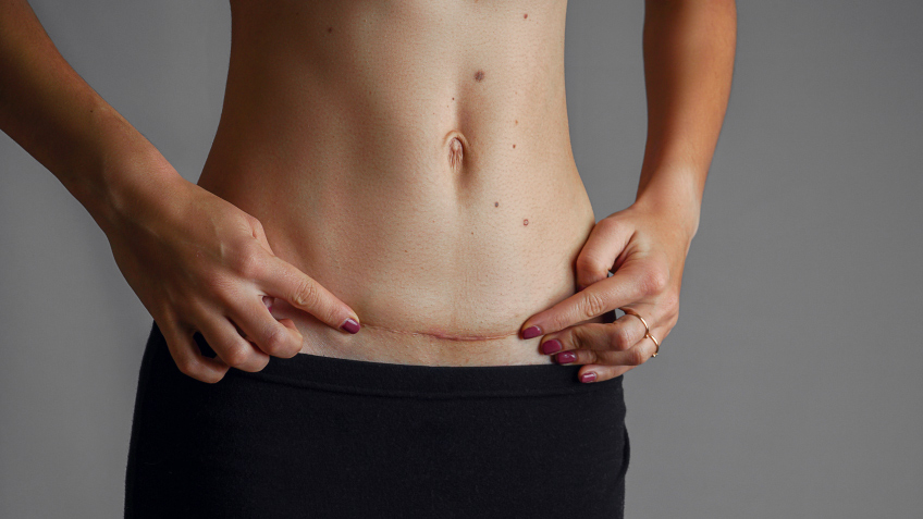 Qué es una cicatriz y cuáles son sus tipos