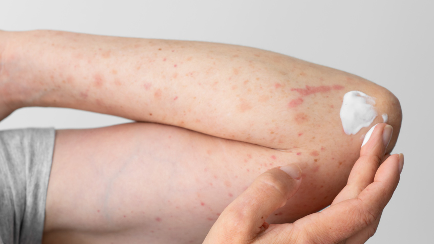 Foliculitis: qué es y cómo se trata