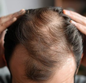 Alopecia: qué es, causas y tipos de alopecia