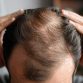 Alopecia: qué es, causas y tipos de alopecia