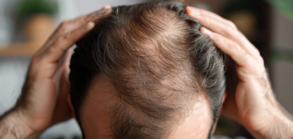 Alopecia: qué es, causas y tipos de alopecia