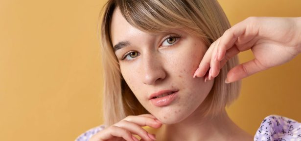 Procedimientos dermatológicos para tratar cicatrices de acné