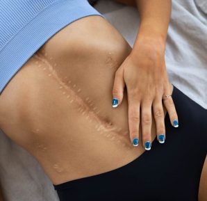 Qué es una cicatriz y cuáles son sus tipos