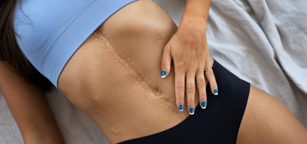 Qué es una cicatriz y cuáles son sus tipos