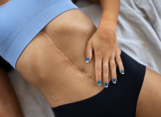 Qué es una cicatriz y cuáles son sus tipos