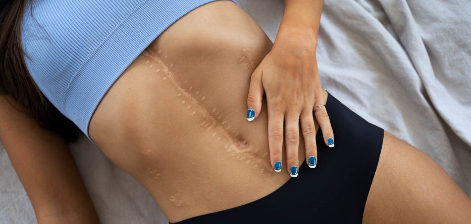 Qué es una cicatriz y cuáles son sus tipos