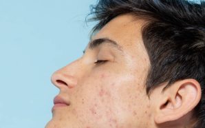 Foliculitis: qué es y cómo se trata