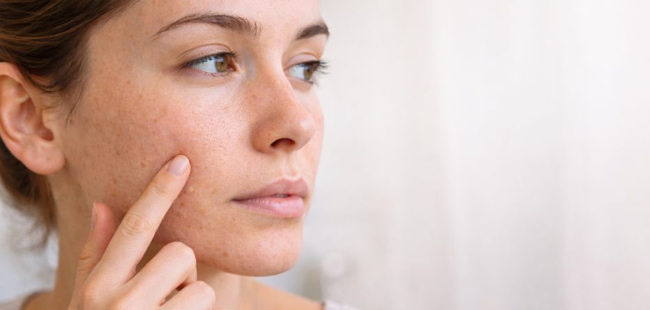 Poros dilatados: causas y cómo mejorar su apariencia